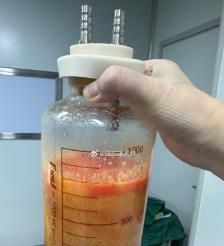 肇庆水动力吸脂手术要做多久？